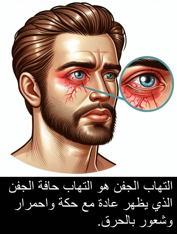 واحمرار: التهاب الجفن هو التهاب حافة الجفن الذي يظهر عادة مع حكة واحمرار وشعور بالحرق.