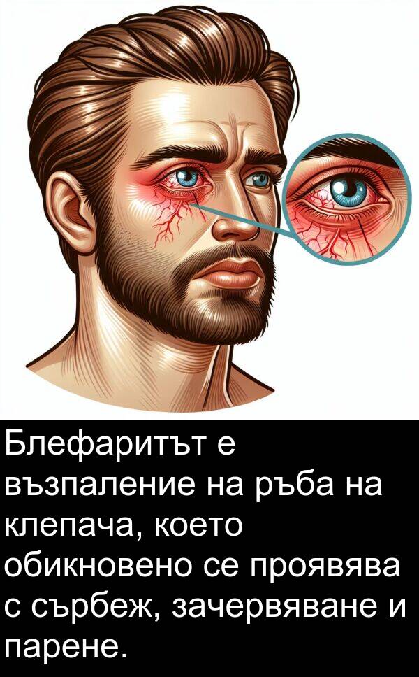 парене: Блефаритът е възпаление на ръба на клепача, което обикновено се проявява с сърбеж, зачервяване и парене.