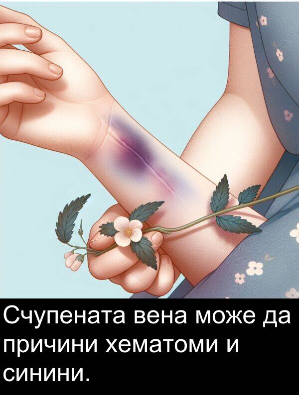 може: Счупената вена може да причини хематоми и синини.