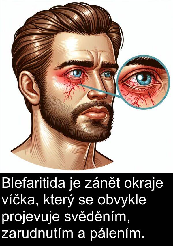 pálením: Blefaritida je zánět okraje víčka, který se obvykle projevuje svěděním, zarudnutím a pálením.