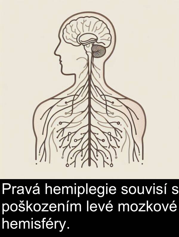 hemisféry: Pravá hemiplegie souvisí s poškozením levé mozkové hemisféry.