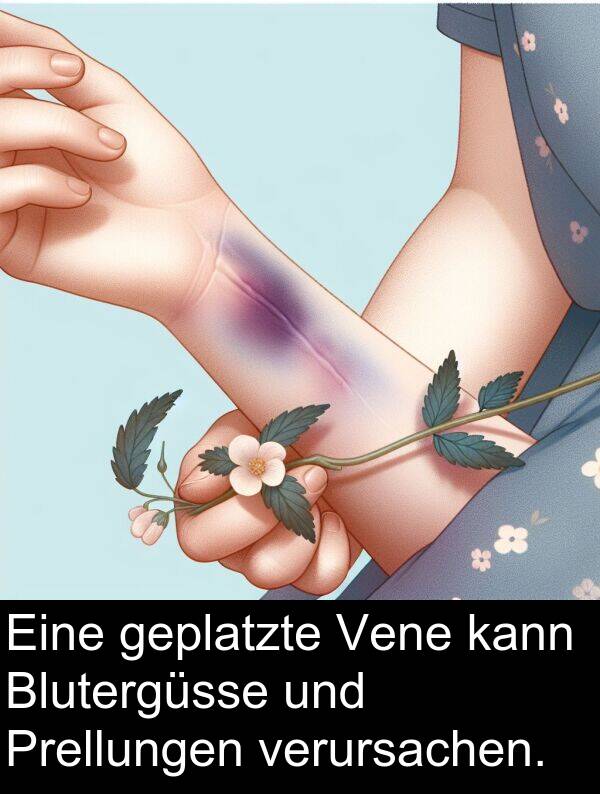Vene: Eine geplatzte Vene kann Blutergüsse und Prellungen verursachen.