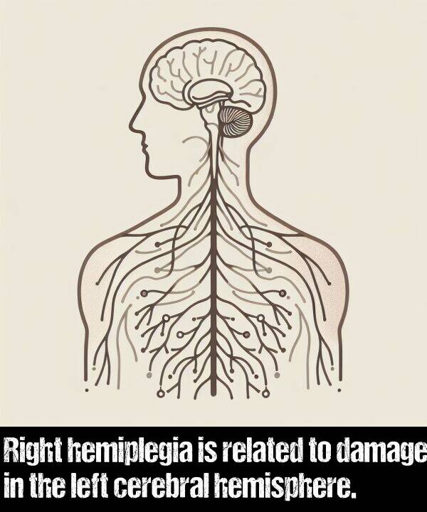 left: Right hemiplegia is related to damage in the left cerebral hemisphere.