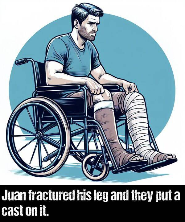 leg: Juan fractured his leg and they put a cast on it.