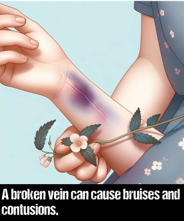 bruises: A broken vein can cause bruises and contusions.
