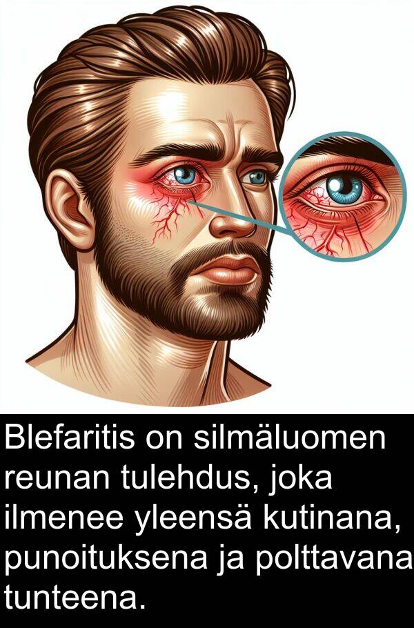 silmäluomen: Blefaritis on silmäluomen reunan tulehdus, joka ilmenee yleensä kutinana, punoituksena ja polttavana tunteena.