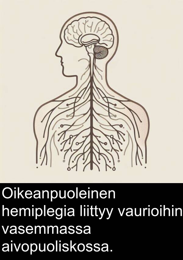 vasemmassa: Oikeanpuoleinen hemiplegia liittyy vaurioihin vasemmassa aivopuoliskossa.