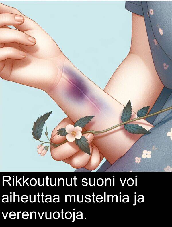 suoni: Rikkoutunut suoni voi aiheuttaa mustelmia ja verenvuotoja.