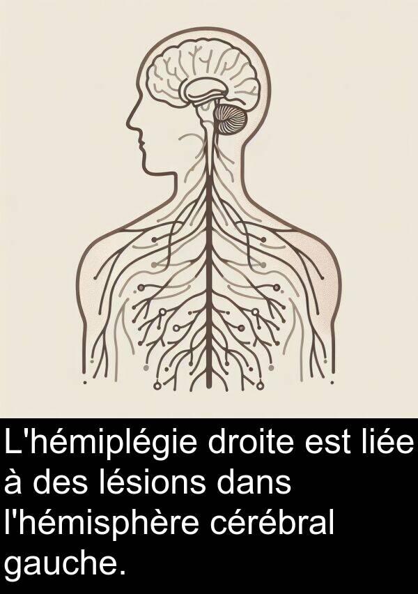 gauche: L'hémiplégie droite est liée à des lésions dans l'hémisphère cérébral gauche.