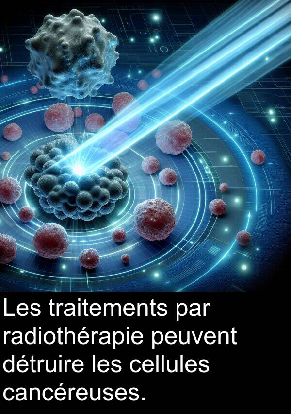 radiothérapie: Les traitements par radiothérapie peuvent détruire les cellules cancéreuses.