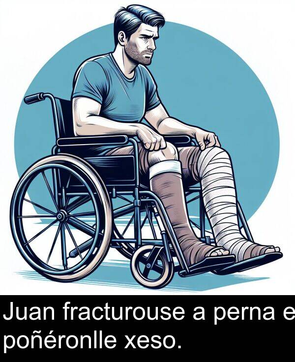 fracturouse: Juan fracturouse a perna e poñéronlle xeso.