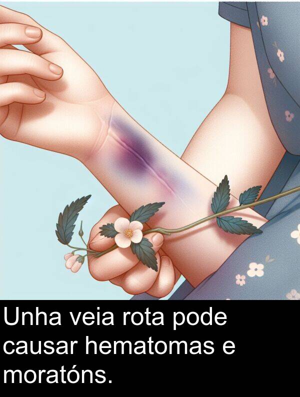 rota: Unha veia rota pode causar hematomas e moratóns.