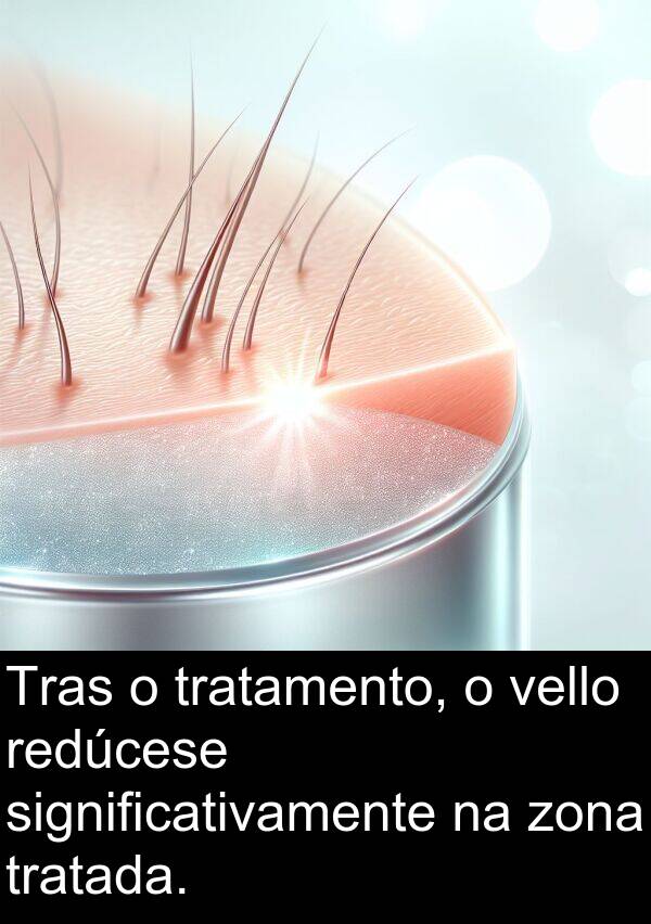 redúcese: Tras o tratamento, o vello redúcese significativamente na zona tratada.