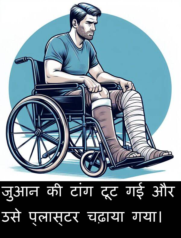 उसे: जुआन की टांग टूट गई और उसे प्लास्टर चढ़ाया गया।