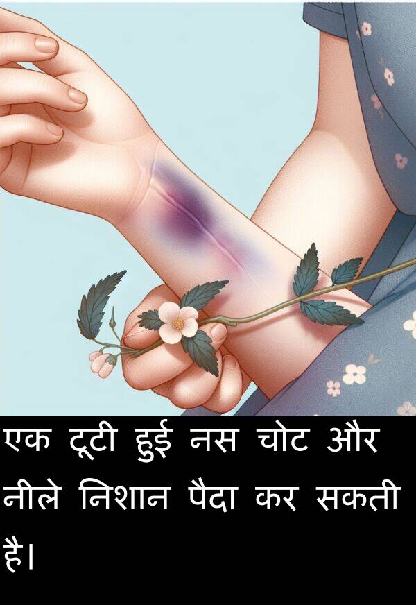 निशान: एक टूटी हुई नस चोट और नीले निशान पैदा कर सकती है।