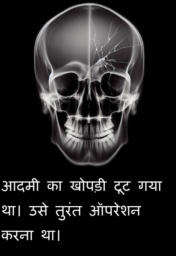 खोपड़ी: आदमी का खोपड़ी टूट गया था। उसे तुरंत ऑपरेशन करना था।