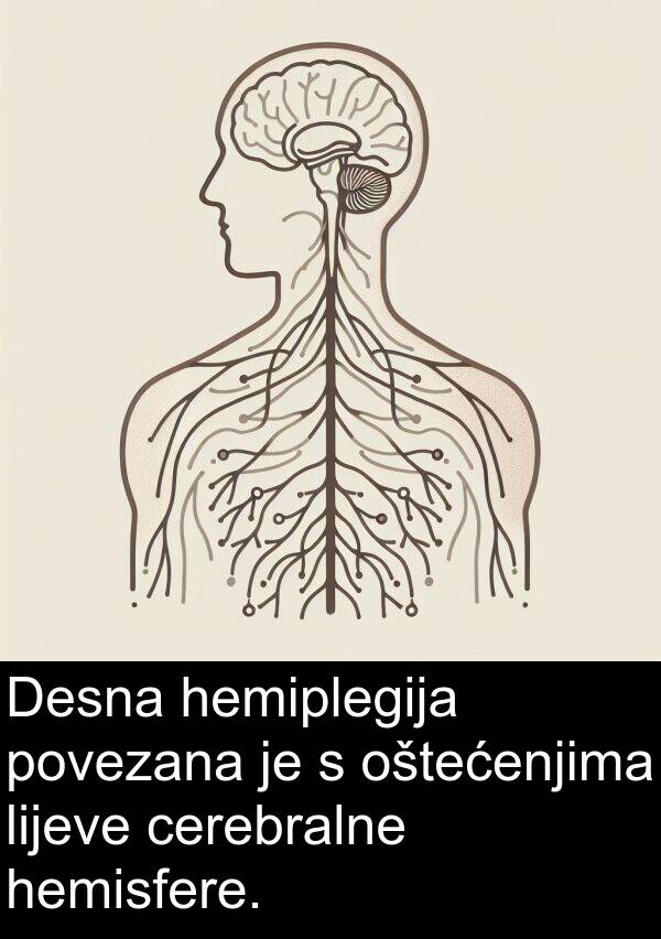 hemisfere: Desna hemiplegija povezana je s oštećenjima lijeve cerebralne hemisfere.