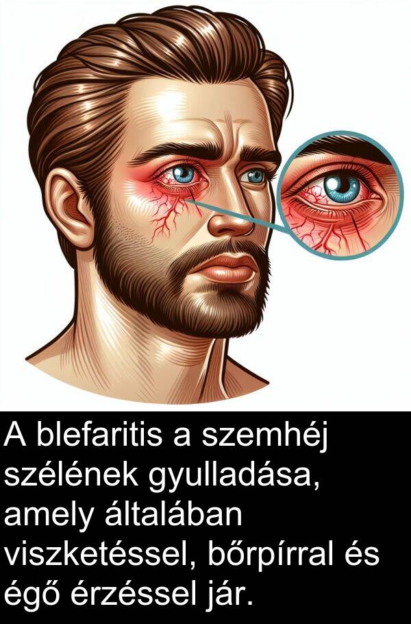 általában: A blefaritis a szemhéj szélének gyulladása, amely általában viszketéssel, bőrpírral és égő érzéssel jár.