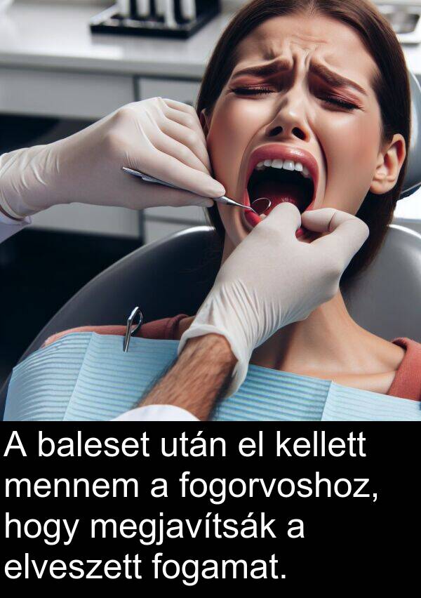 baleset: A baleset után el kellett mennem a fogorvoshoz, hogy megjavítsák a elveszett fogamat.