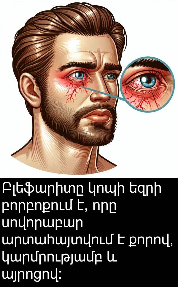 բորբոքում: Բլեֆարիտը կոպի եզրի բորբոքում է, որը սովորաբար արտահայտվում է քորով, կարմրությամբ և այրոցով: