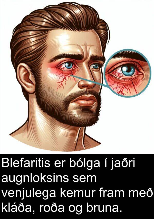 kemur: Blefaritis er bólga í jaðri augnloksins sem venjulega kemur fram með kláða, roða og bruna.