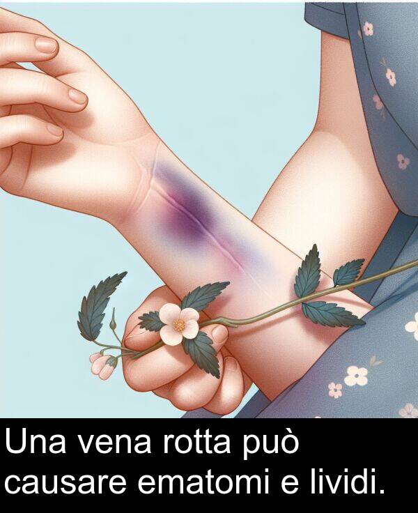 rotta: Una vena rotta può causare ematomi e lividi.