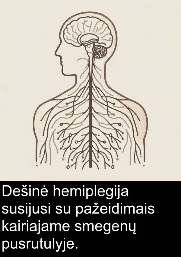 kairiajame: Dešinė hemiplegija susijusi su pažeidimais kairiajame smegenų pusrutulyje.