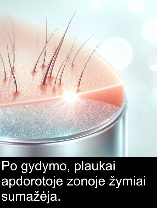 zonoje: Po gydymo, plaukai apdorotoje zonoje žymiai sumažėja.