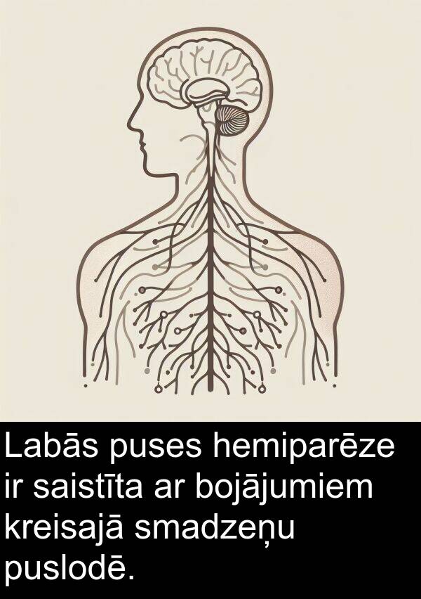 kreisajā: Labās puses hemiparēze ir saistīta ar bojājumiem kreisajā smadzeņu puslodē.