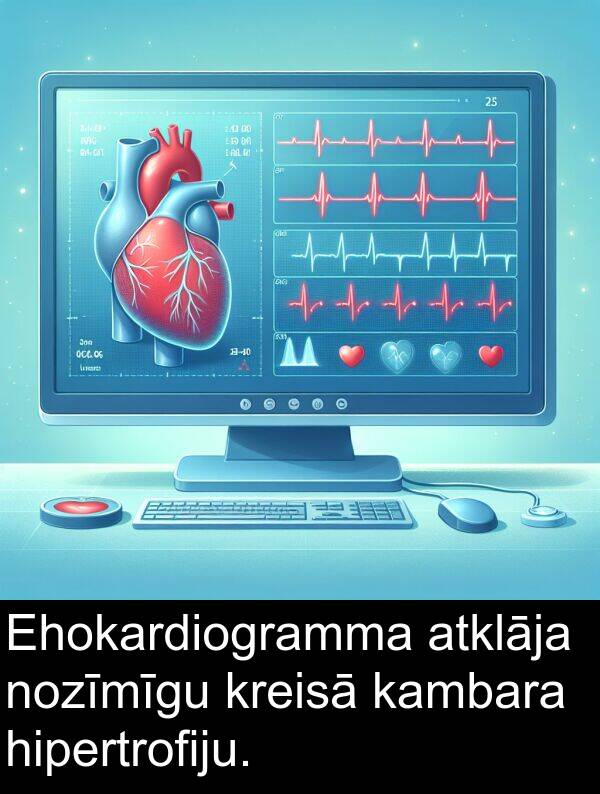 kreisā: Ehokardiogramma atklāja nozīmīgu kreisā kambara hipertrofiju.