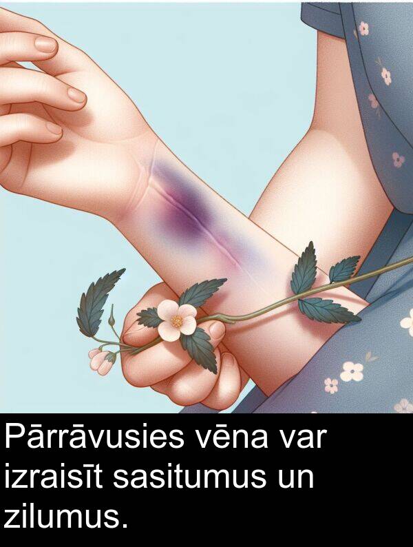 zilumus: Pārrāvusies vēna var izraisīt sasitumus un zilumus.