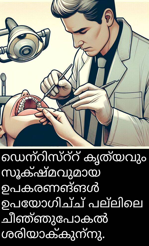 കൃത്യവും: ഡെന്റിസ്റ്റ് കൃത്യവും സൂക്ഷ്മവുമായ ഉപകരണങ്ങൾ ഉപയോഗിച്ച് പല്ലിലെ ചീഞ്ഞുപോകൽ ശരിയാക്കുന്നു.