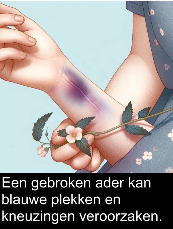 plekken: Een gebroken ader kan blauwe plekken en kneuzingen veroorzaken.