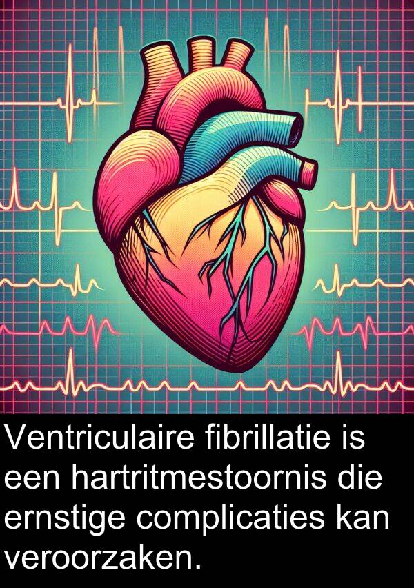 fibrillatie: Ventriculaire fibrillatie is een hartritmestoornis die ernstige complicaties kan veroorzaken.