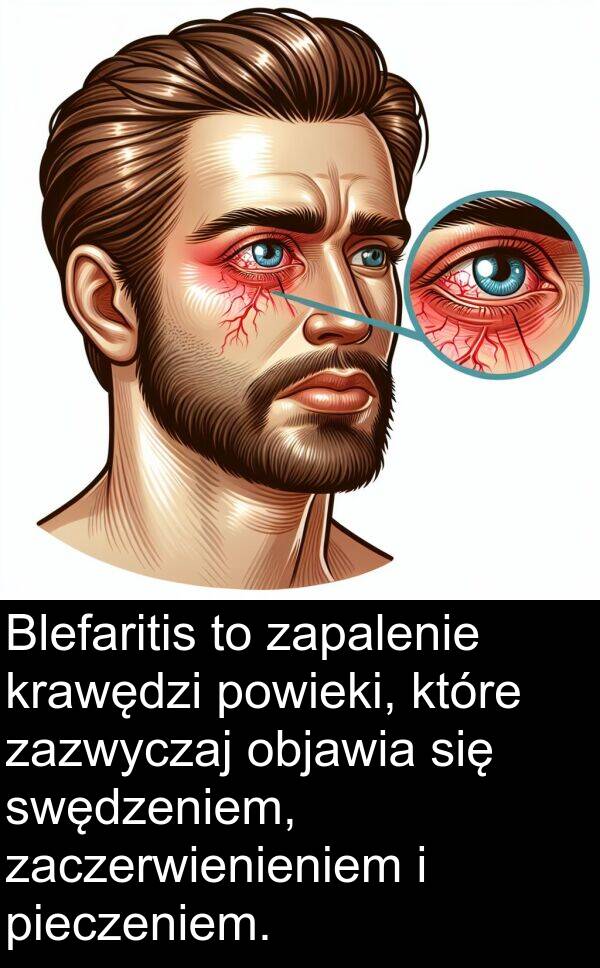 pieczeniem: Blefaritis to zapalenie krawędzi powieki, które zazwyczaj objawia się swędzeniem, zaczerwienieniem i pieczeniem.