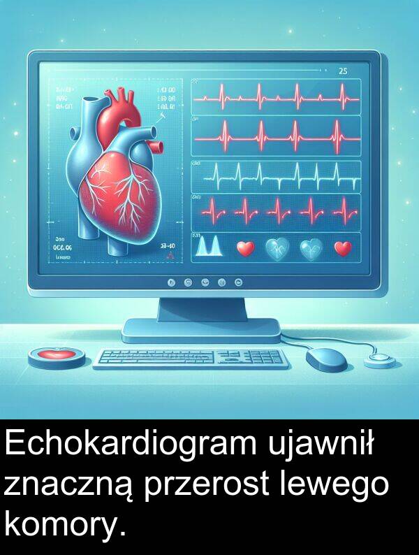 przerost: Echokardiogram ujawnił znaczną przerost lewego komory.