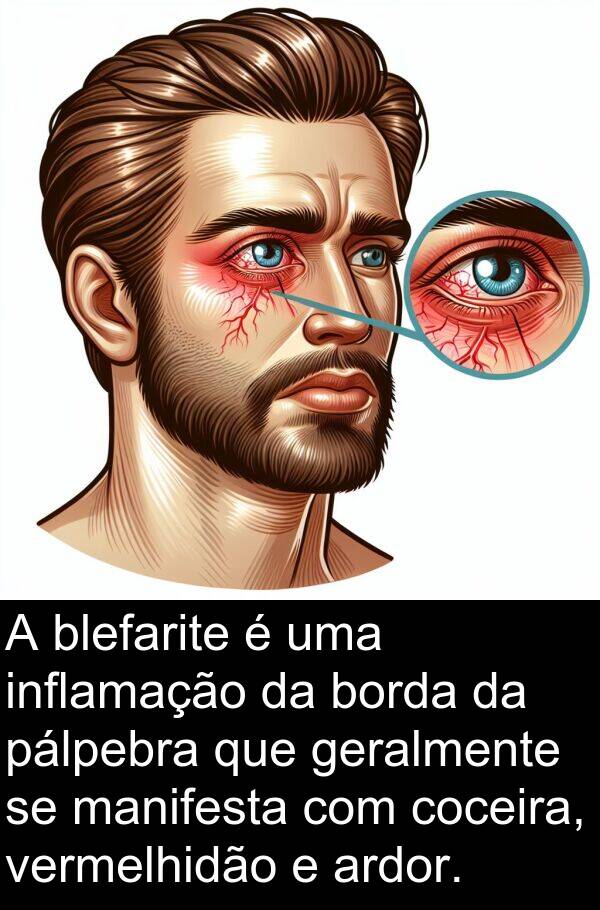 manifesta: A blefarite é uma inflamação da borda da pálpebra que geralmente se manifesta com coceira, vermelhidão e ardor.