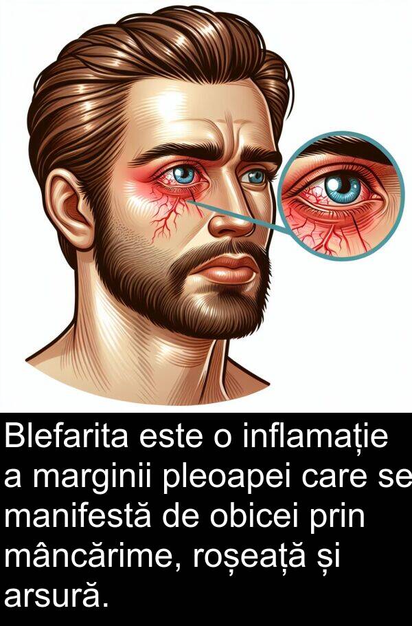 mâncărime: Blefarita este o inflamație a marginii pleoapei care se manifestă de obicei prin mâncărime, roșeață și arsură.