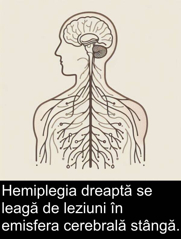 dreaptă: Hemiplegia dreaptă se leagă de leziuni în emisfera cerebrală stângă.