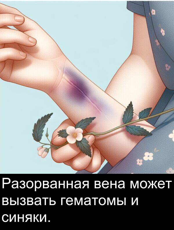 вена: Разорванная вена может вызвать гематомы и синяки.