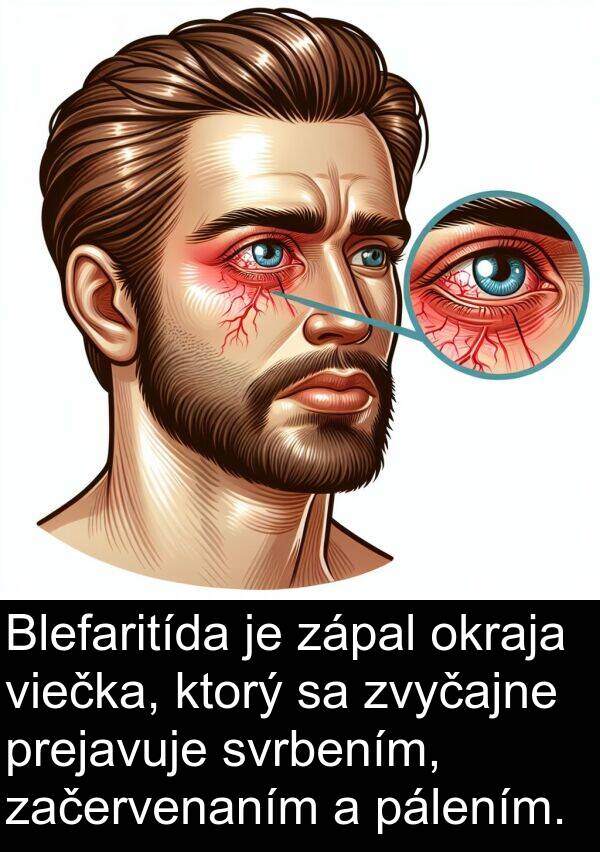 pálením: Blefaritída je zápal okraja viečka, ktorý sa zvyčajne prejavuje svrbením, začervenaním a pálením.