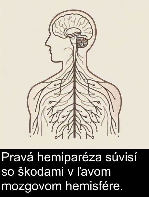škodami: Pravá hemiparéza súvisí so škodami v ľavom mozgovom hemisfére.