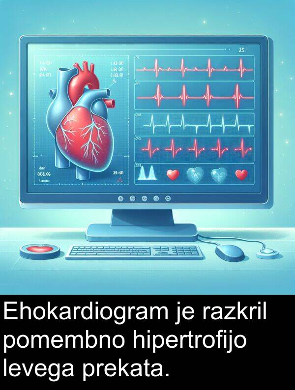 hipertrofijo: Ehokardiogram je razkril pomembno hipertrofijo levega prekata.