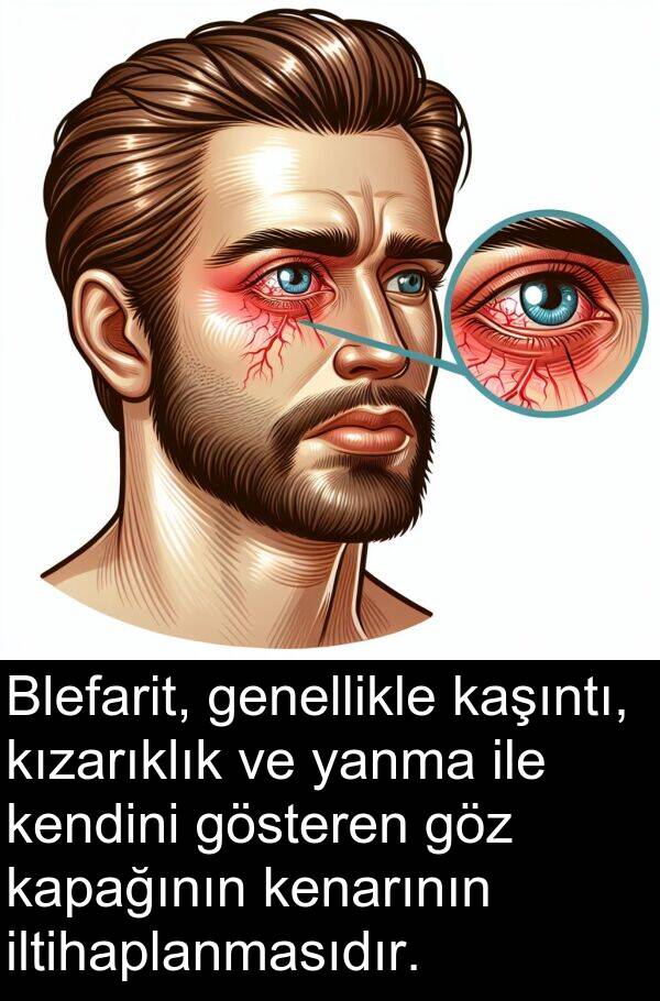 genellikle: Blefarit, genellikle kaşıntı, kızarıklık ve yanma ile kendini gösteren göz kapağının kenarının iltihaplanmasıdır.