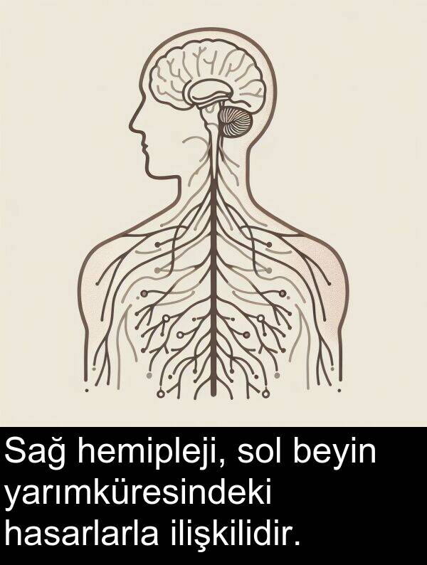ilişkilidir: Sağ hemipleji, sol beyin yarımküresindeki hasarlarla ilişkilidir.