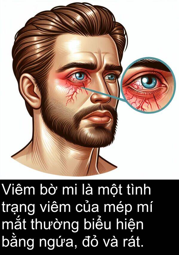 viêm: Viêm bờ mi là một tình trạng viêm của mép mí mắt thường biểu hiện bằng ngứa, đỏ và rát.