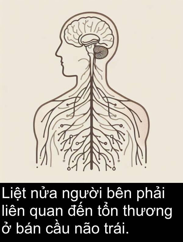 não: Liệt nửa người bên phải liên quan đến tổn thương ở bán cầu não trái.